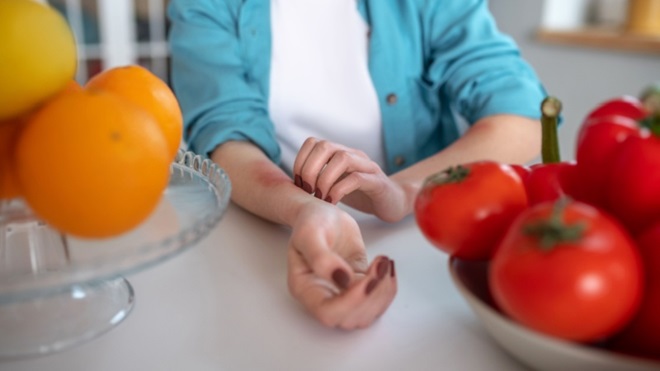 Donna con rossire al braccio e alimenti