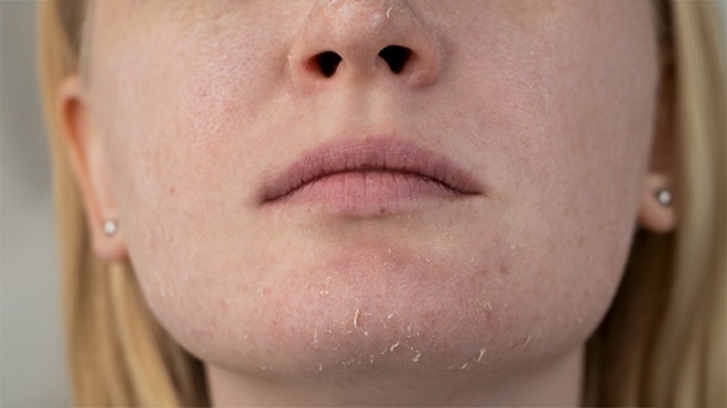 Pelle secca del viso