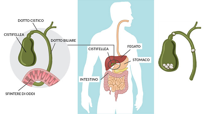 cistifellea e stomaco