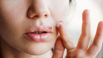 Herpes labiale