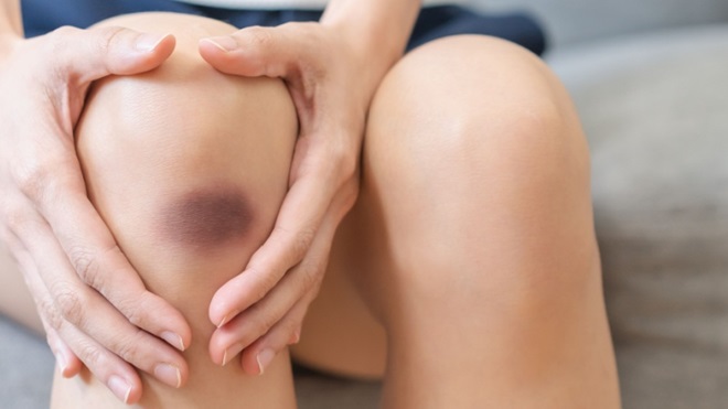 Livido con ematoma ginocchio ragazzo