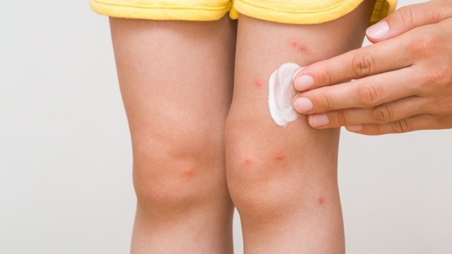 Gambe di bambino con punture di zanzare e crema