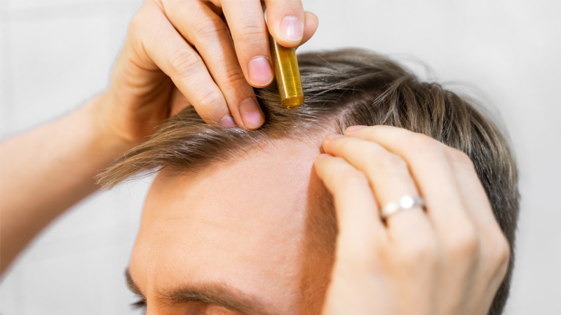 caduta capelli uomo fiala